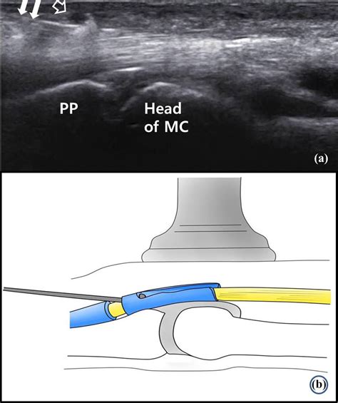 Comparative Study Of Ultrasonography Guided Percutaneous A1 Pulley