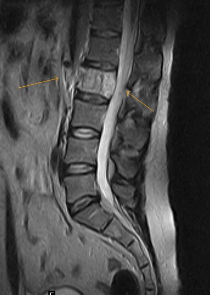 Aggressive Vertebral Hemangioma Sumers Radiology Blog