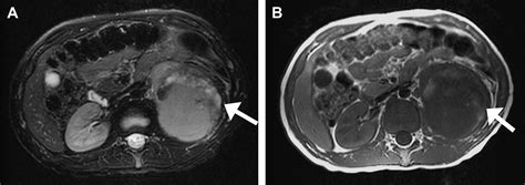 Wilms Tumor And Other Pediatric Renal Masses Magnetic Resonance