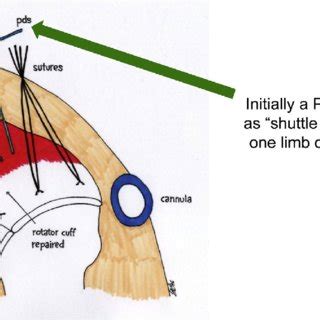 Flach (typ i), gebogen (typ ii) oder hakenförmig (typ iii = hooked akromion) mrt: Bigliani ' s classification of acromion undersurface with ...