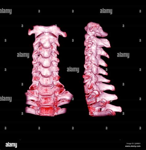 Ct Scan Of Cervical Spine C Spine Patient Trauma Case 3d Rendering