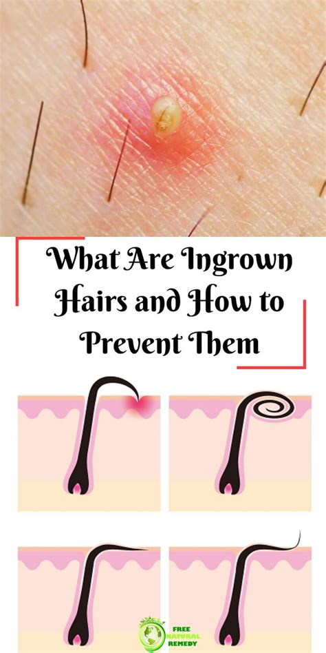 Download How To Remove Ingrown Hair  Goodprintablecouponsforenfamil