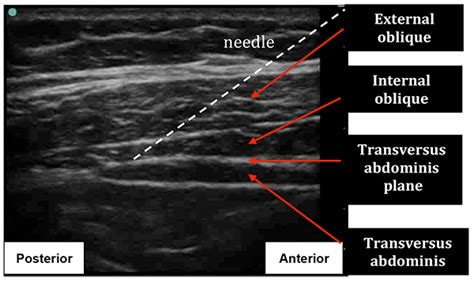 Transversus Abdominis Plane Block Wfsa Resources