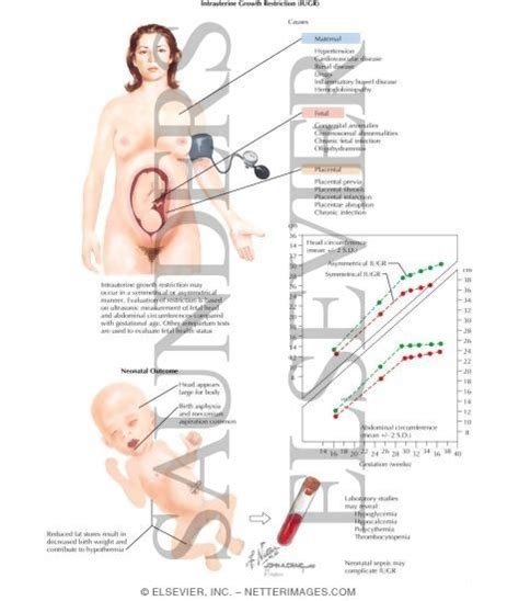 Check spelling or type a new query. Intrauterine growth restriction. Causes, symptoms ...