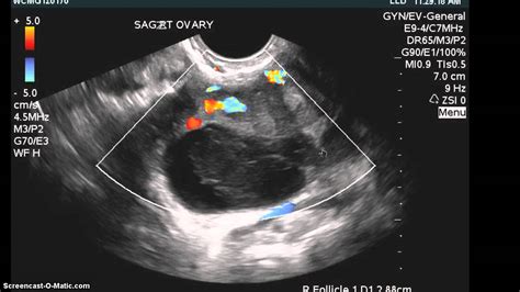 Endometriosis Ovarian Cysts Histology