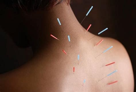 Acupuncture For Chronic Pain Alternative Resources Directory