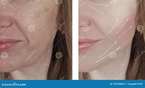 Woman Wrinkles Face Before And After Procedures Regeneration Stock
