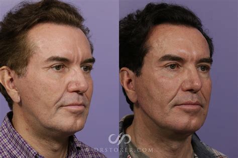 Jawline Fillers Before And After Pictures Case Marina Del Rey CA Stoker Plastic Surgery