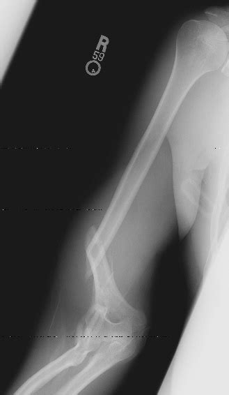 Arm Wrestle Bone Fracture Xray Home Remedies Log