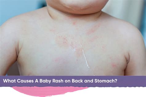 Baby Rash On Back And Stomach How To Identify Treat And Prevent