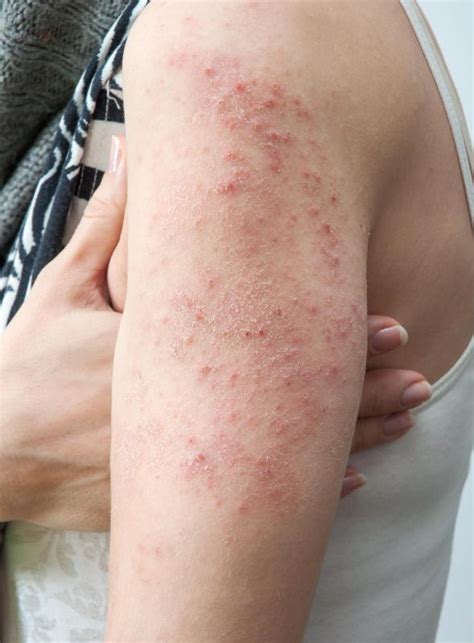 What Is A Diabetic Rash With Pictures