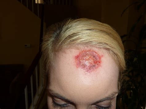 See melanoma pictures to determine which skin characteristics may be of concern. Adventures of Team Kelso: This is what skin cancer looks like