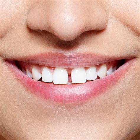 How do i get rid of the small gaps between your teeth after periodontitis? Porcelain Veneers for Gaps - Canton, OH - Dr. Bruce E. Treiber