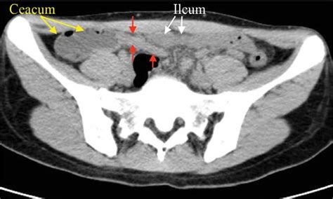 Practical Points In Diagnosis Of Acute Appendicitis By Ct Image Andor