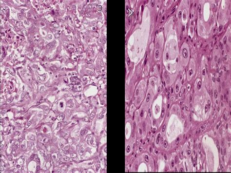 Carcinoma Ex Adenoma Pleomorfico