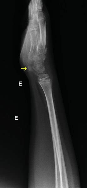 Lateral Radiography View Of The Left Wrist Showing The Anterior