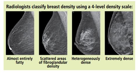 new law requires breast density findings in mammogram reports linda rhodes