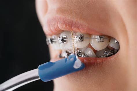 Cleaning Your Braces Orthodontic Treatment Thorndon
