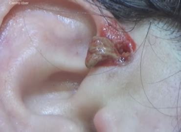 These following symptoms of ingrown hairs will help you recognize it at an early stage: Ingrown hair, Pilonidal Cyst Removing Lots of Ingrown Hair
