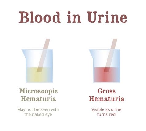 Hematuria Blood In The Urine Asui
