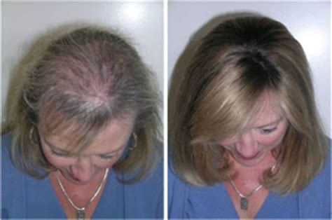 Women's hair loss is caused by any number of factors, but what truly matters is the solution. Herbal Supplements: 8 Natural and Effective Hair Loss Solution
