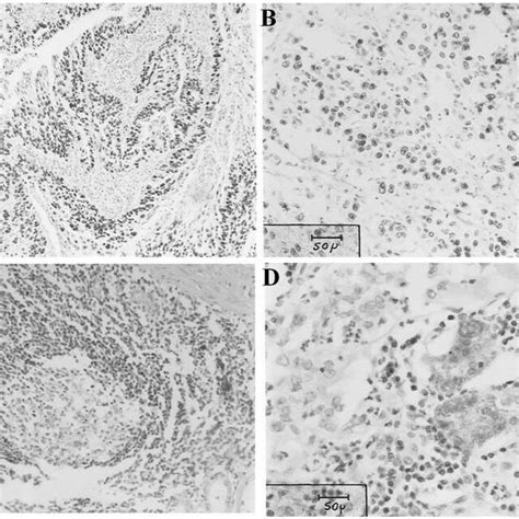 A D Immunohistochemical Staining Of P53 And Bcl 2 Proteins In Primary