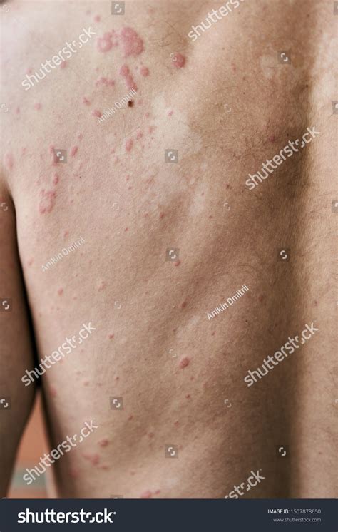 Skin Imperfection Skin Allergy Urticaria Disease Stock Photo 1507878650