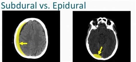 Easily learn the differences between a subdural vs epidural hematoma or hemorrhage, and the ct scan findings of each. Ellese Sakai-Hart on Twitter: "Imaging differences between ...