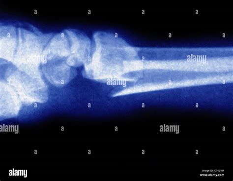 Fractured Wrist X Ray Stock Photo Alamy