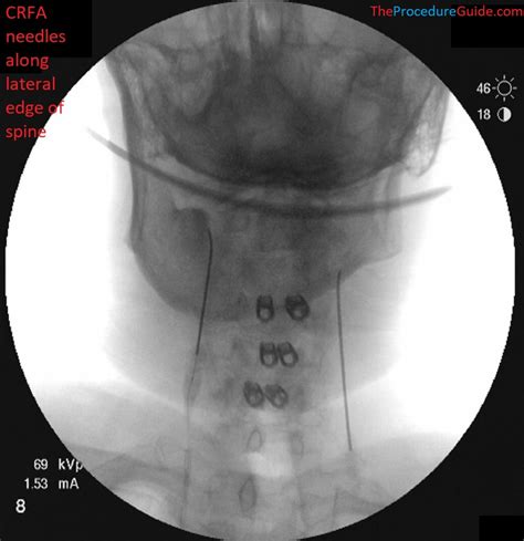 Fluoroscopic Guided Cervical Medial Branch Radiofrequency Ablation