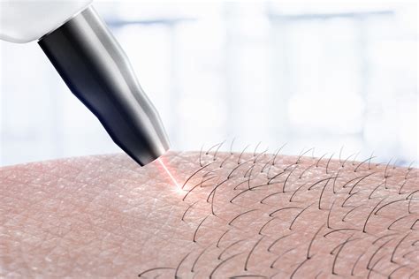 In many cases, waxing also removes the top layer of. Laser Hair Removal - Roma Skin Care Clinic