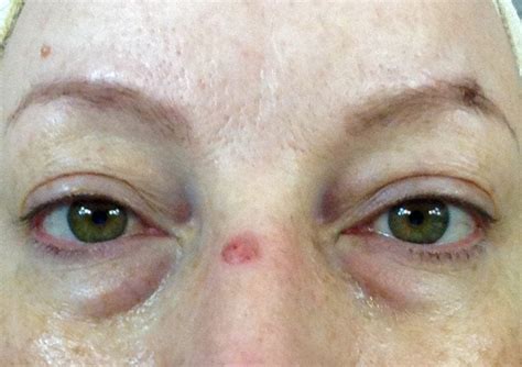 Red Spot Skin Cancer On Nose