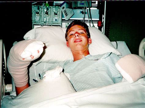Shark Attack Victim Gets Bionic Leg Photo 5 Pictures Cbs News