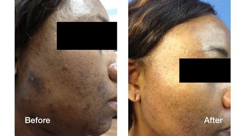 Dark Skin Laser Skin Care Treatments Skin Perfect Brothers In Walnut