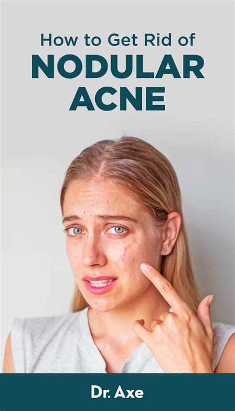 Nodular Acne Symptoms Causes Treatments And More Dr Axe