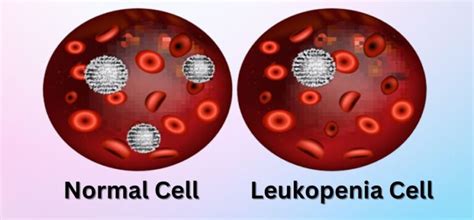 Low White Blood Cell Leukopenia Causes Medical Elevate