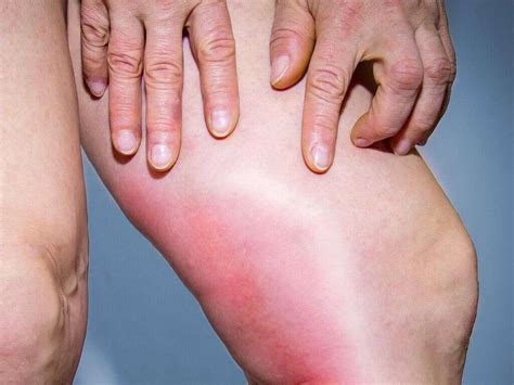 Blood Clot Symptoms Arm
