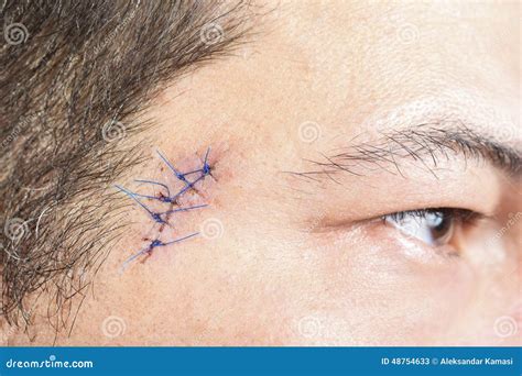 Stitches On Man Face Stock Image Image Of Birthmark 48754633