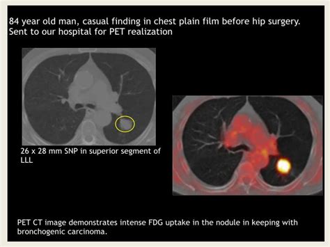 Radiological Imaging Of Single Solitary Pulmonary Nodule