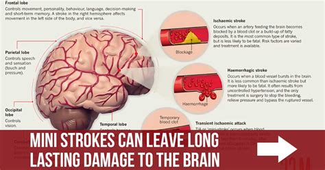 Mini Strokes Can Leave Long Lasting Damage To The Brain
