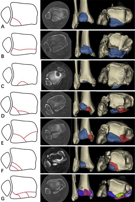 Morphological Analysis And Classification Of Posterior Malleolar Fractures Based On Ct Scans