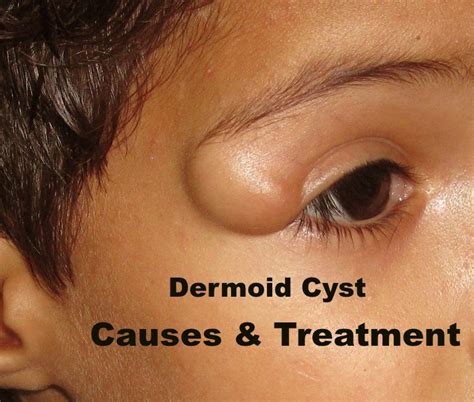 Facial Dermoid Cyst Removal
