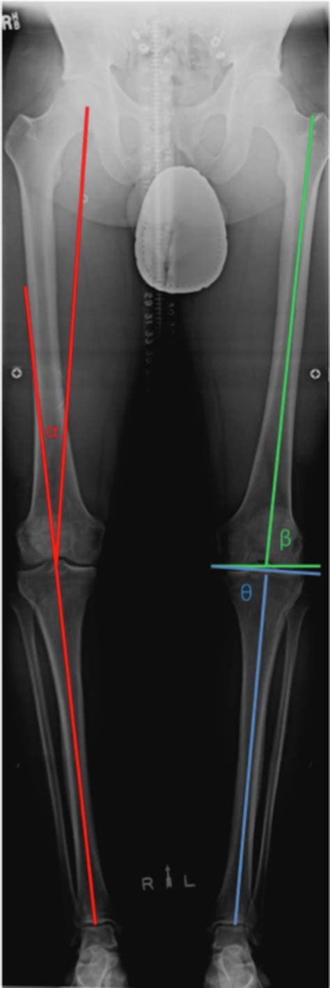 Genu Valgum Correction And Biplanar Osteotomies Clinics In Sports Medicine