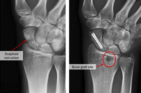 Scaphoid Fracture Raleigh Hand Surgery Joseph J Schreiber MD