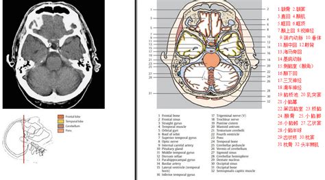颅脑ct解剖对照图 影像ppt