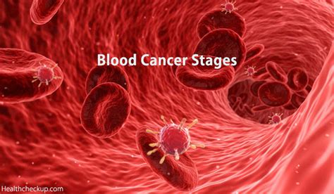 Blood Cancer Stages And Survival Rates Health Checkup