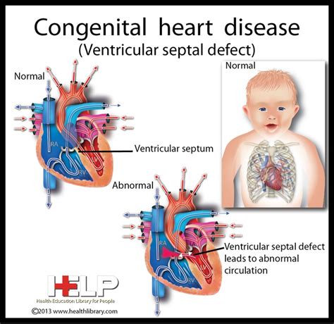 Congenital What Is Congenital Heart Defect
