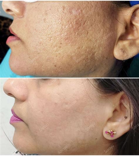 Does Laser Treatment Get Rid Of Acne Scars