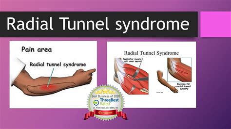 Radial Tunnel Syndrome Youtube