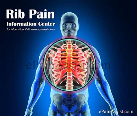 Rib Pain Information Centerbruised Ribsrib Cartilage Injuryfracture